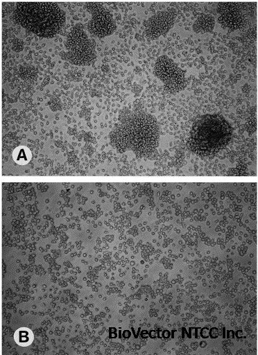 Malignant hematopoietic cell lines:in vitro models for the study of multiple myeloma and plasma cell leukemia - ScienceDirect