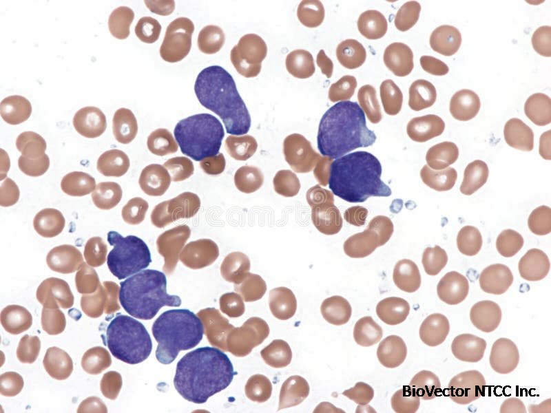 T-cell Acute Lymphoid Leukemia. Bone Marrow. Stock Photo - Image of lymphocytes, lymphoblastic:349353254