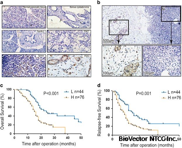 Cancer-FOXP3 directly activated CCL5 to recruit FOXP3+Treg cells in pancreatic ductal adenocarcinoma | Oncogene