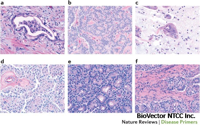 Pancreatic cancer | Nature Reviews Disease Primers
